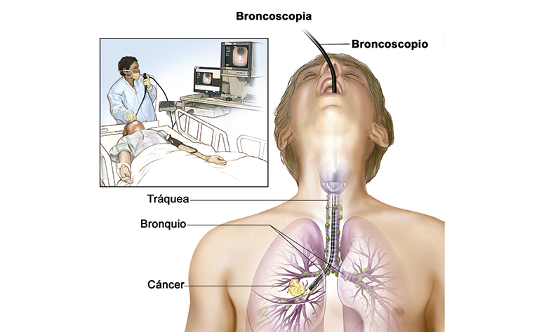 Broncoscopiainterna21